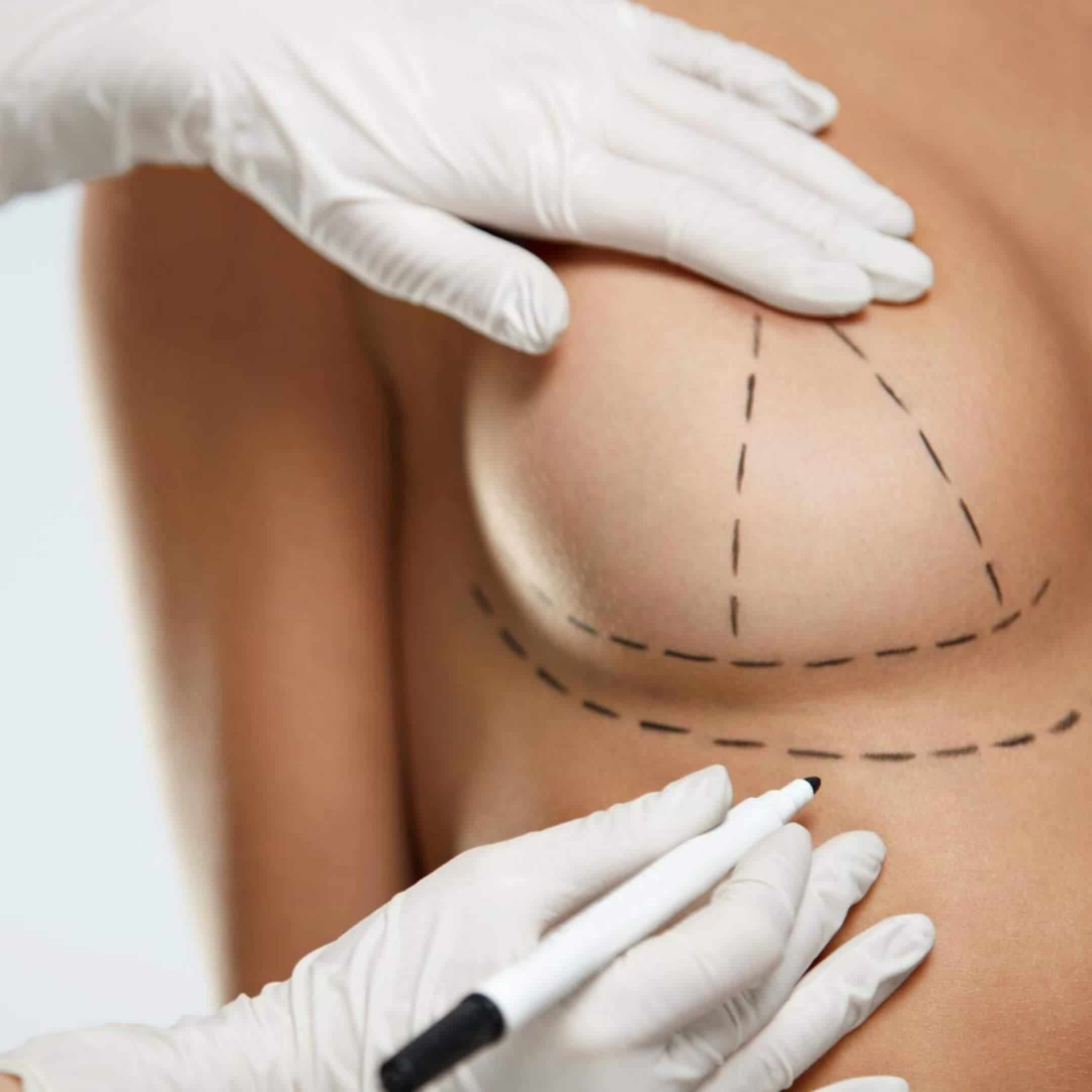 Breast Lift Surgery Newport Beach