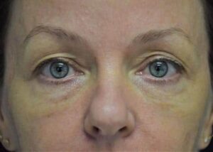 How to Fix Droopy Eyelids | Newport Beach