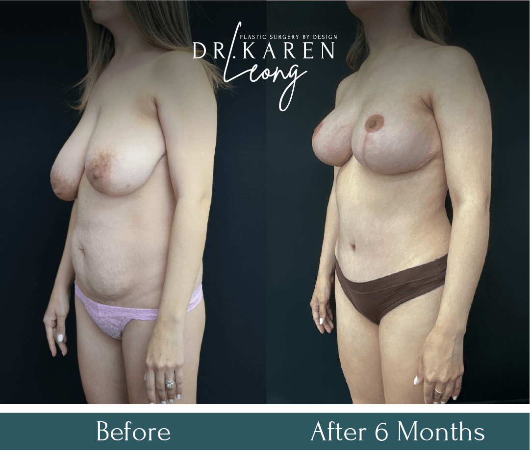 Dr-Karen-Leong-Before-After-AM-Breast-Reduction_0-copy-3-1.png