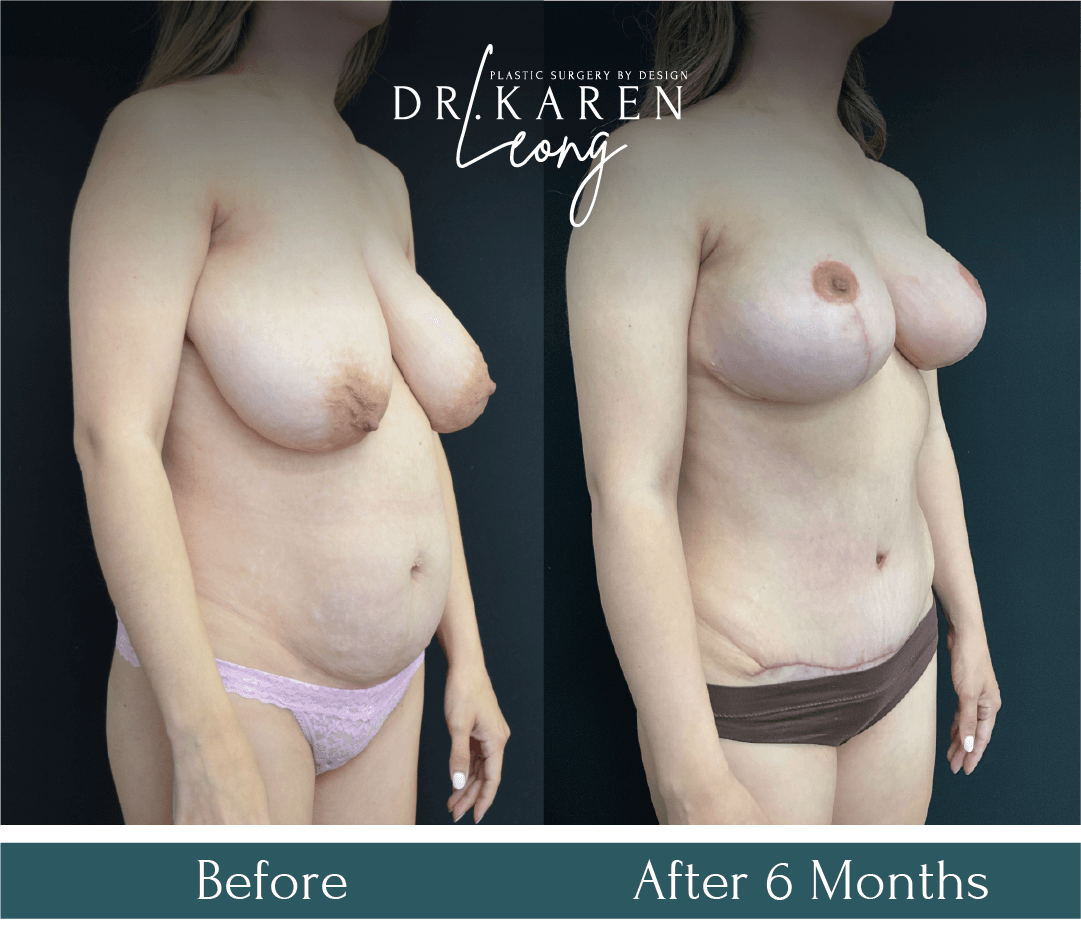 Dr-Karen-Leong-Before-After-AM-Breast-Reduction_0-copy-4-1.png