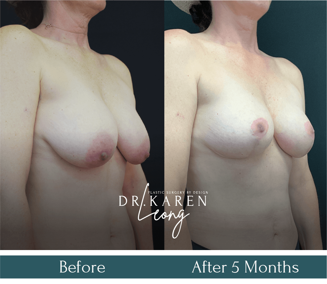 Dr Karen Leong Before After - Breast Aug Fat Transfer