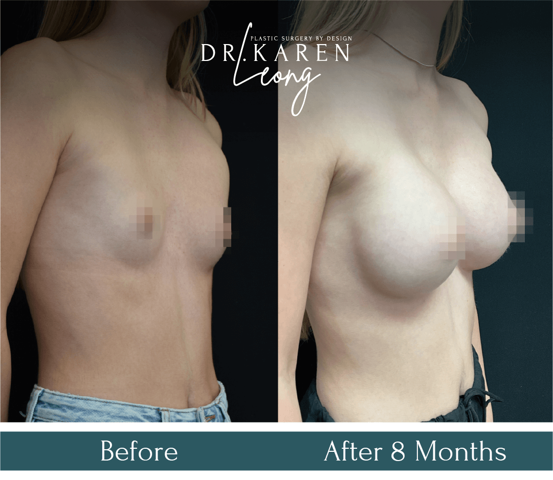 Dr Karen Leong Before After - Breast Augmentation