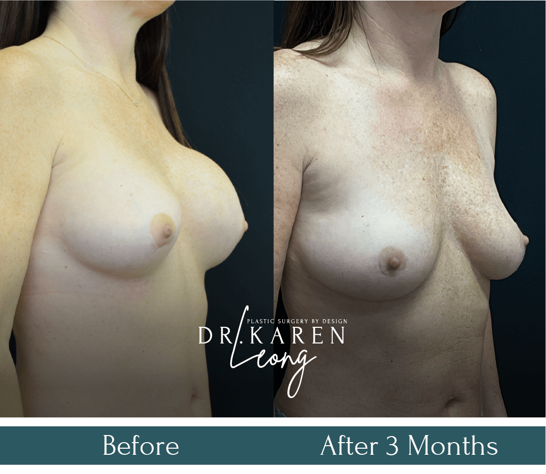 Dr-Karen-Leong-Before-After-Breast-Fat-Transfer_NS-copy-2.png