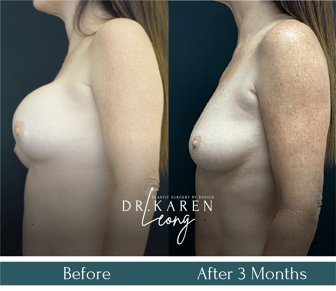 Dr-Karen-Leong-Before-After-Breast-Fat-Transfer_NS-copy-3.png