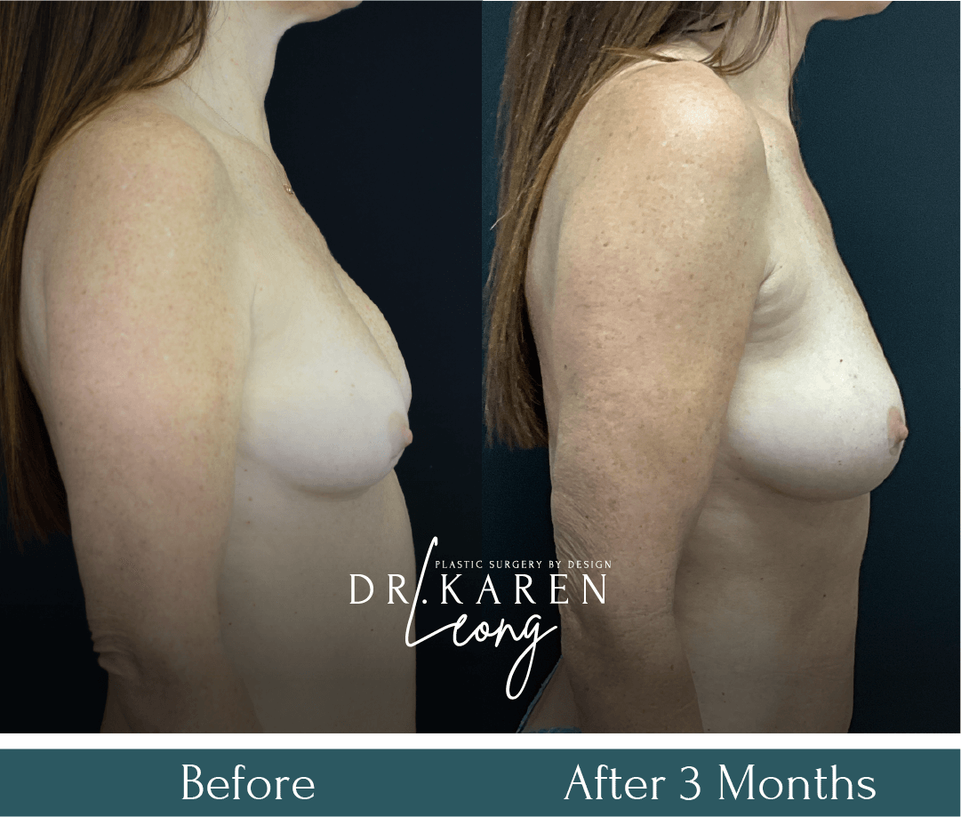 Dr-Karen-Leong-Before-After-Breast-Fat-Transfer_NS-copy-6.png
