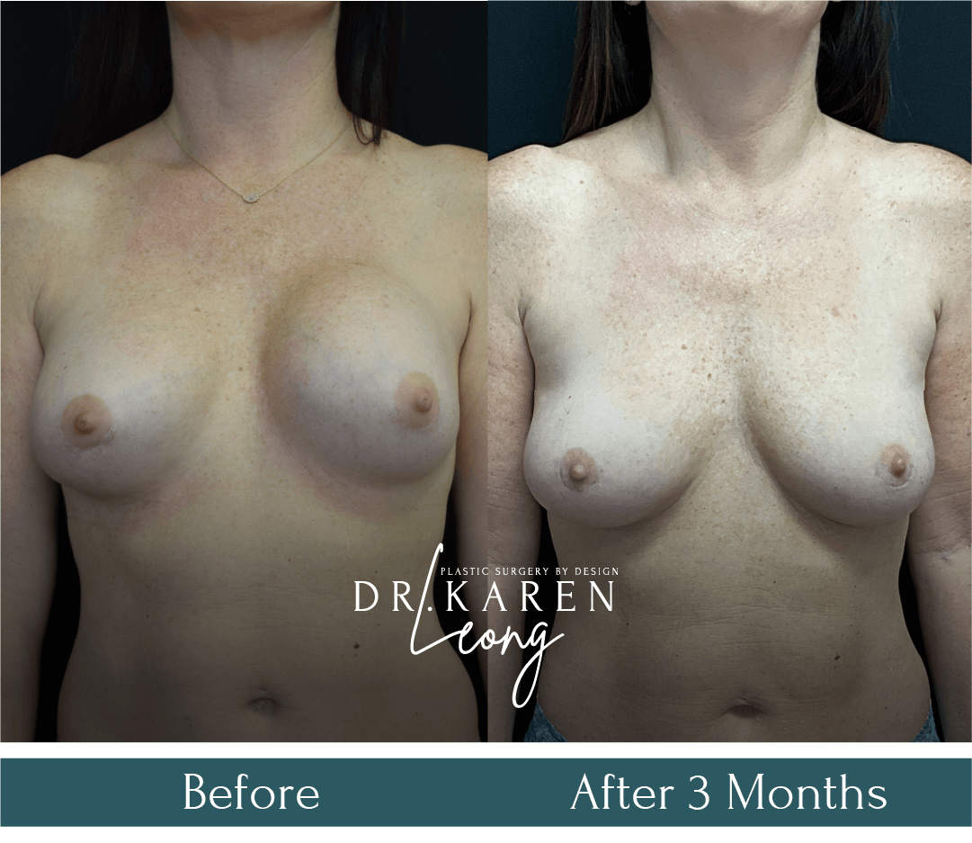Dr-Karen-Leong-Before-After-Breast-Fat-Transfer_NS.png