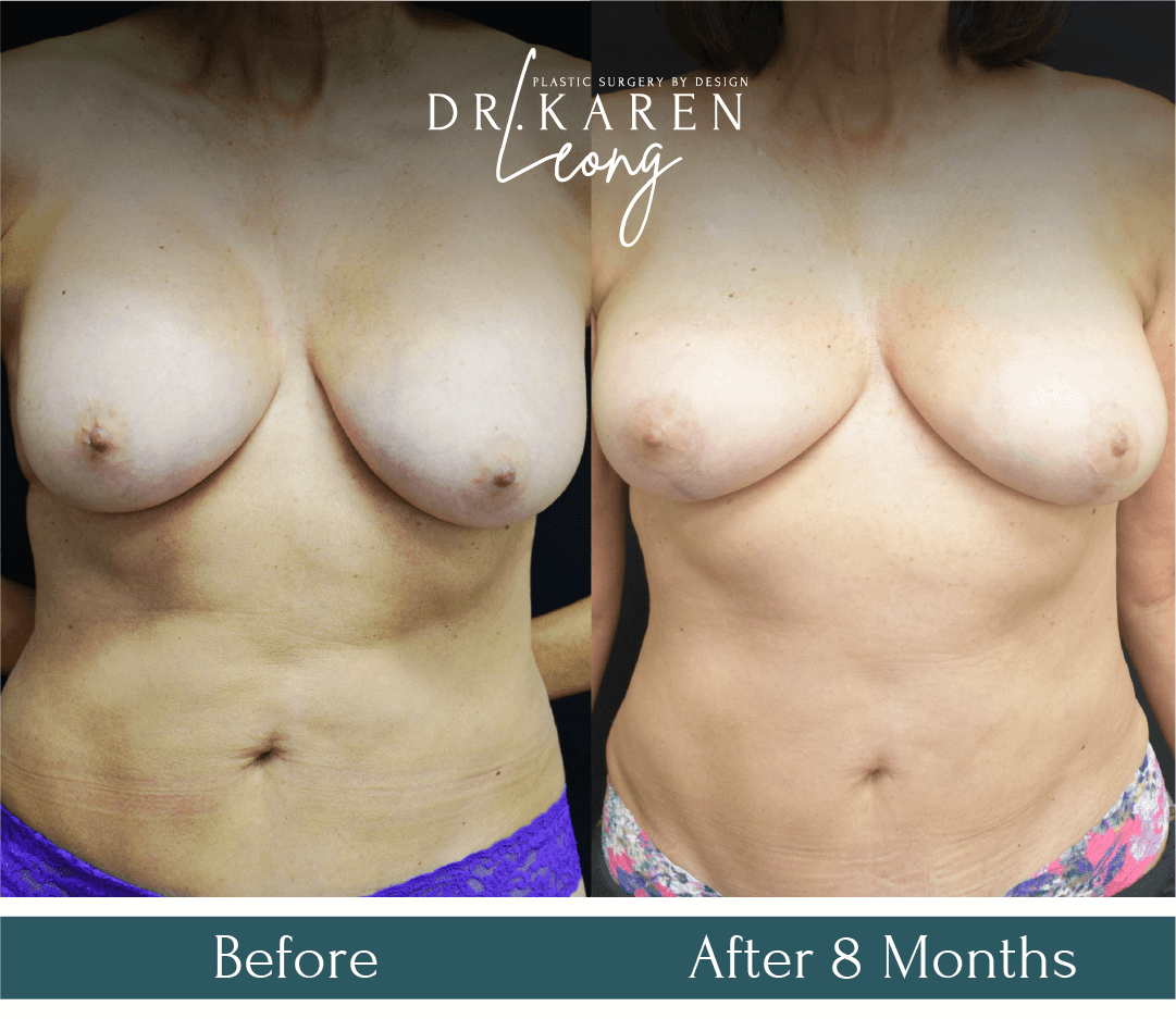 Dr Karen Leong Before After - Breast Implant Removal