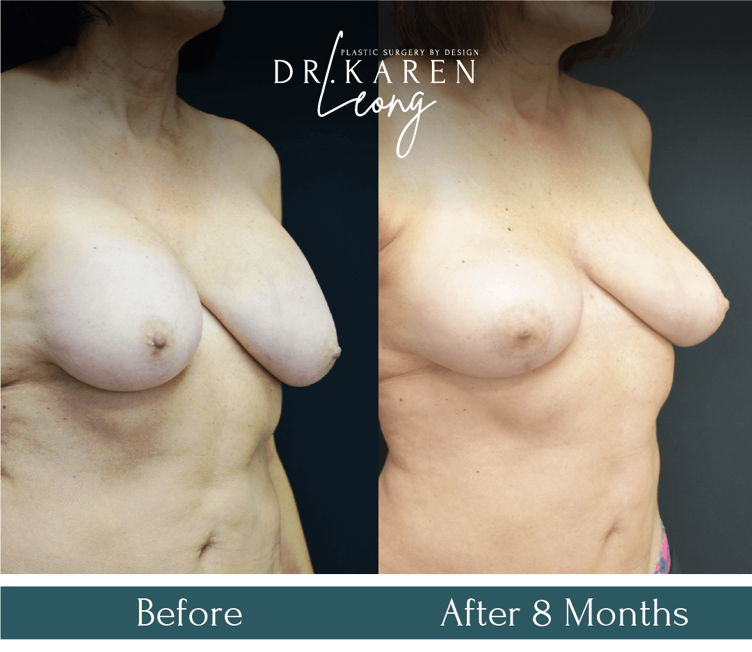 Dr Karen Leong Before After - Breast Implant Removal