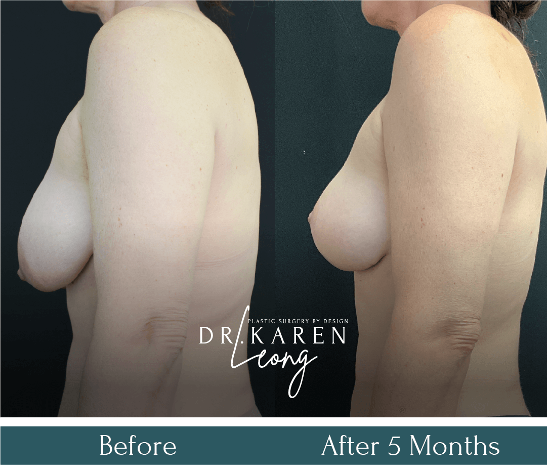 Dr Karen Leong Before After - Breast Lift