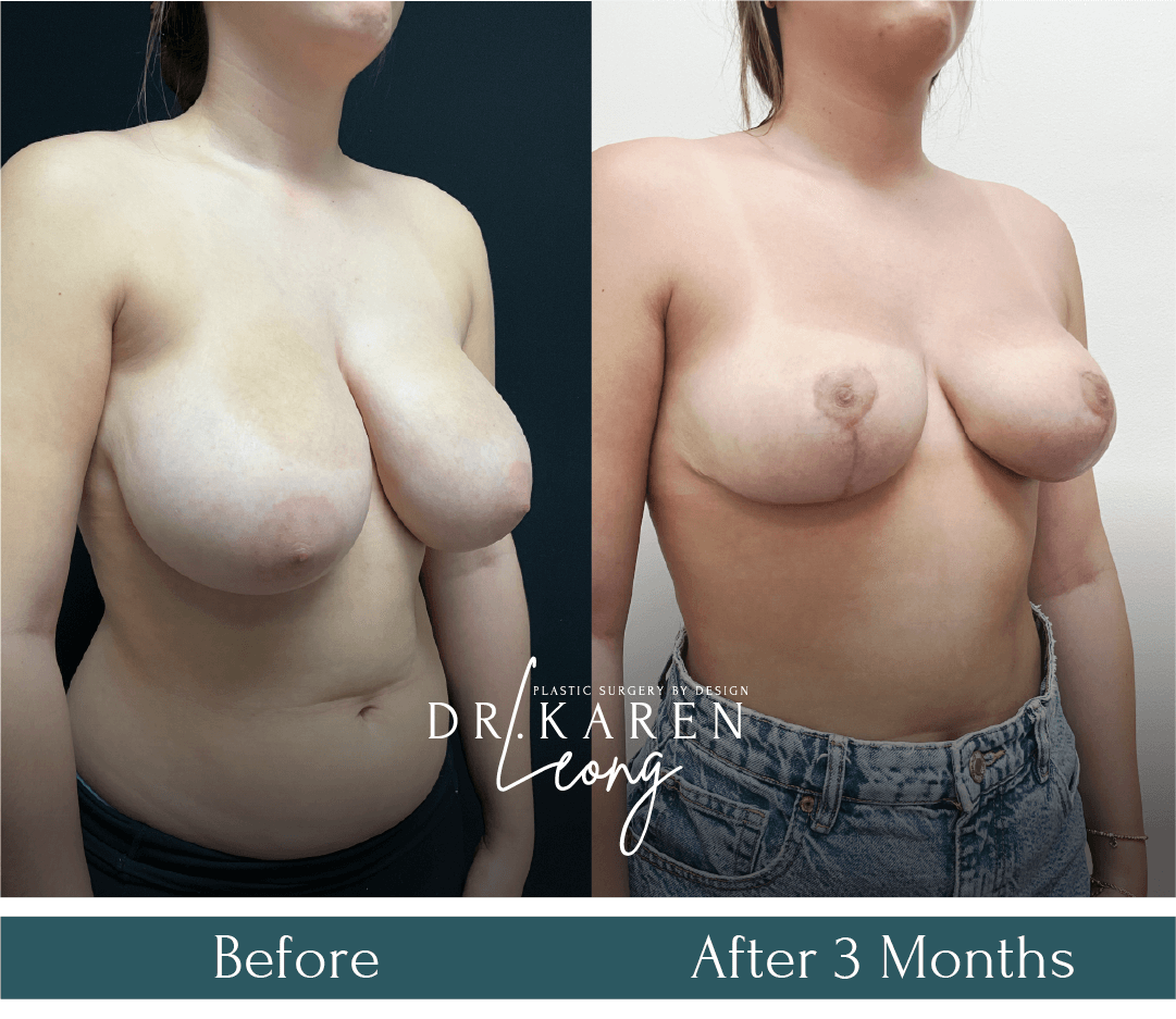 Dr Karen Leong Before After - Breast Reduction