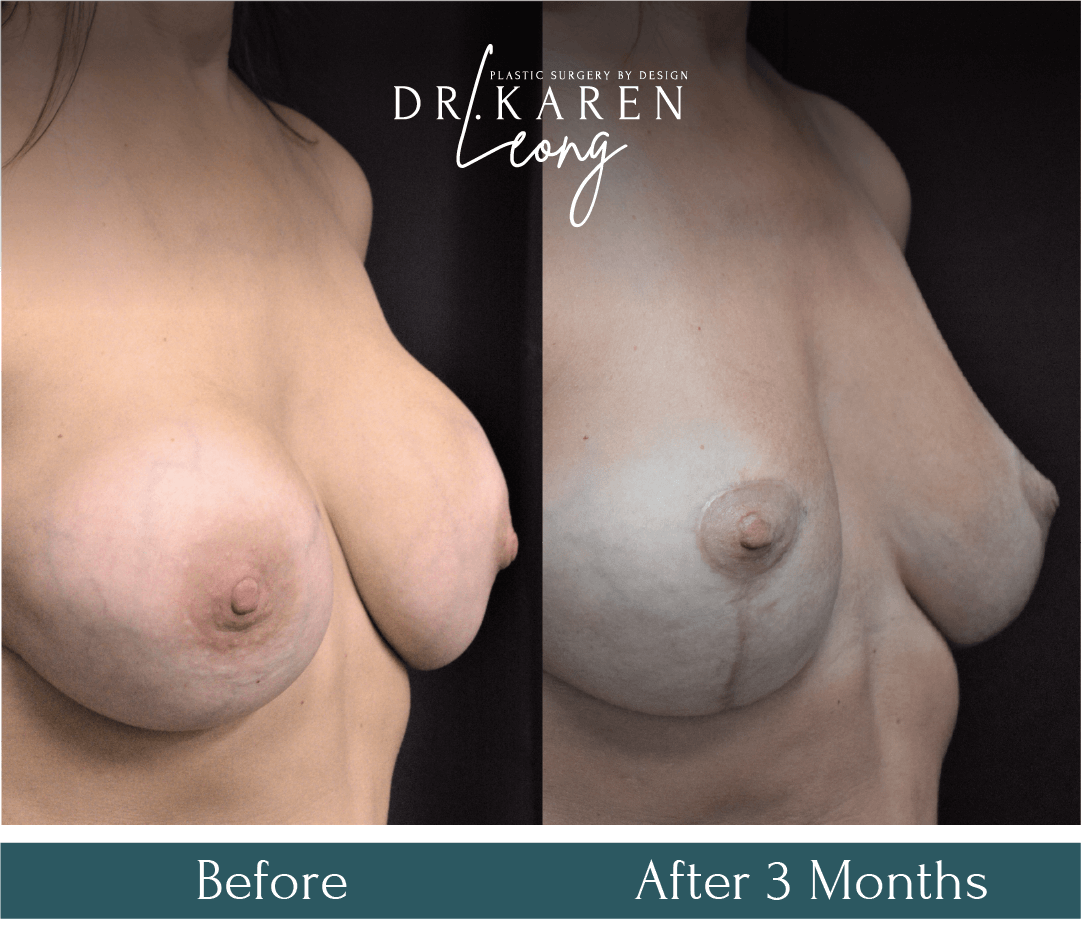 Dr Karen Leong Before After - Breast Revision