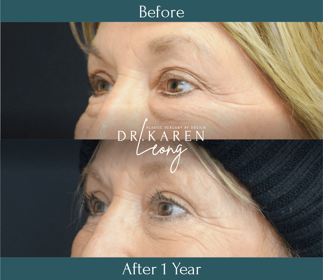 Dr Karen Leong Before After - Eyelid Lift