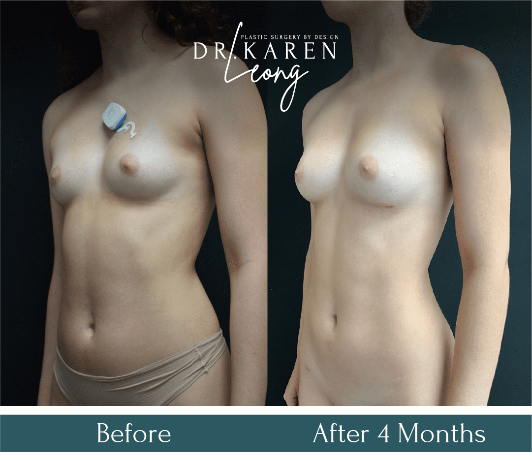 Dr-Karen-Leong-Before-After-Friedman-Fat-Transfer-Breast_0-copy-6.png