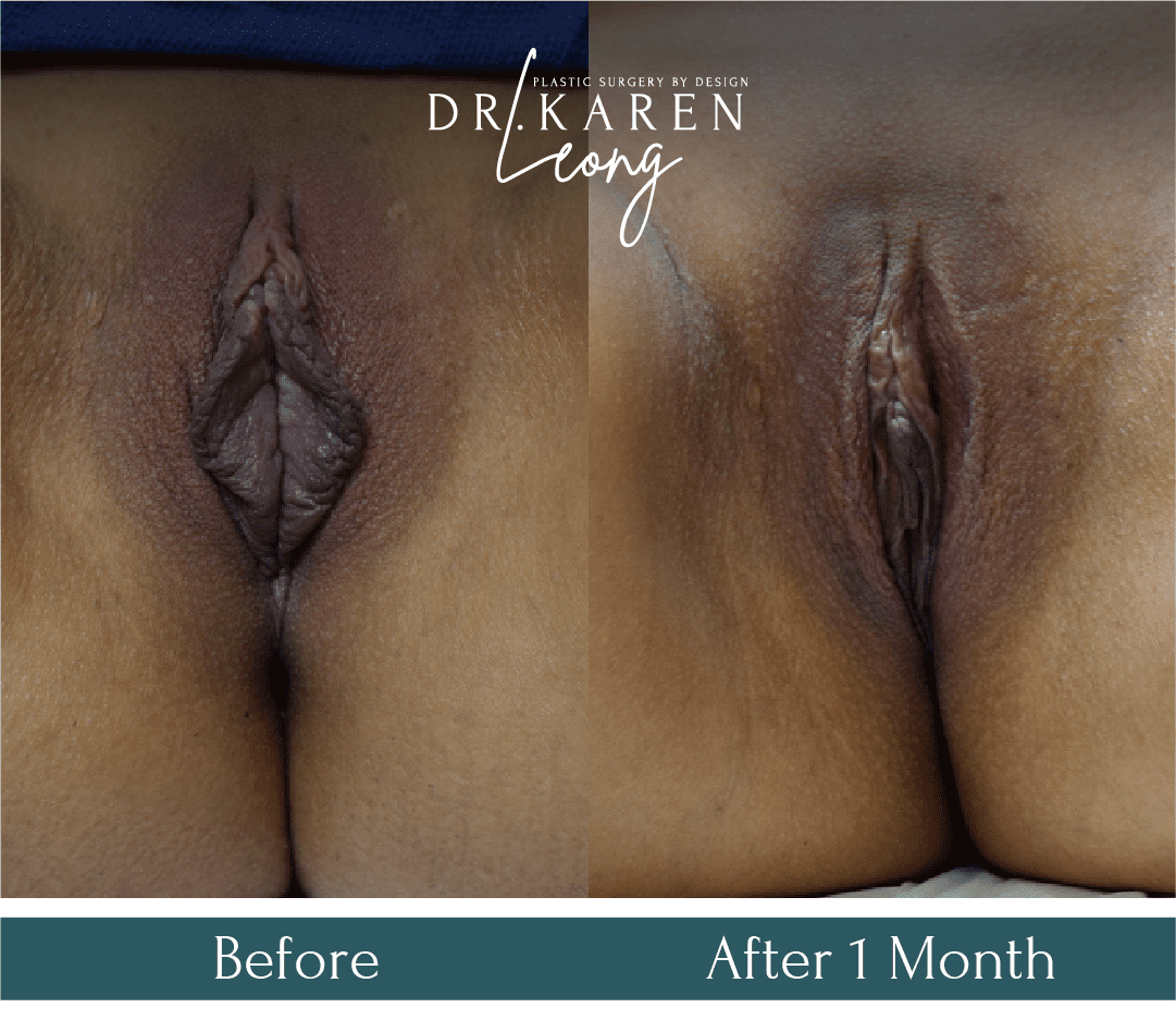 Dr-Karen-Leong-Before-After-Labiaplasty_PT1.png
