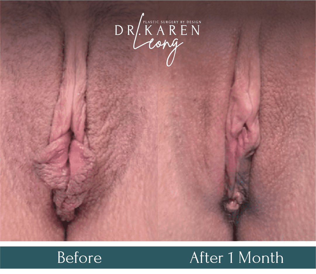 Dr-Karen-Leong-Before-After-Labiaplasty_PT10.png