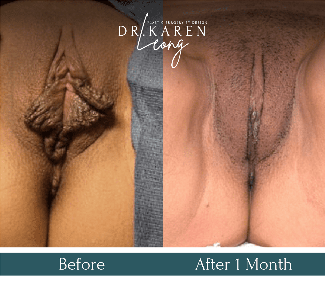 Dr-Karen-Leong-Before-After-Labiaplasty_PT11.png