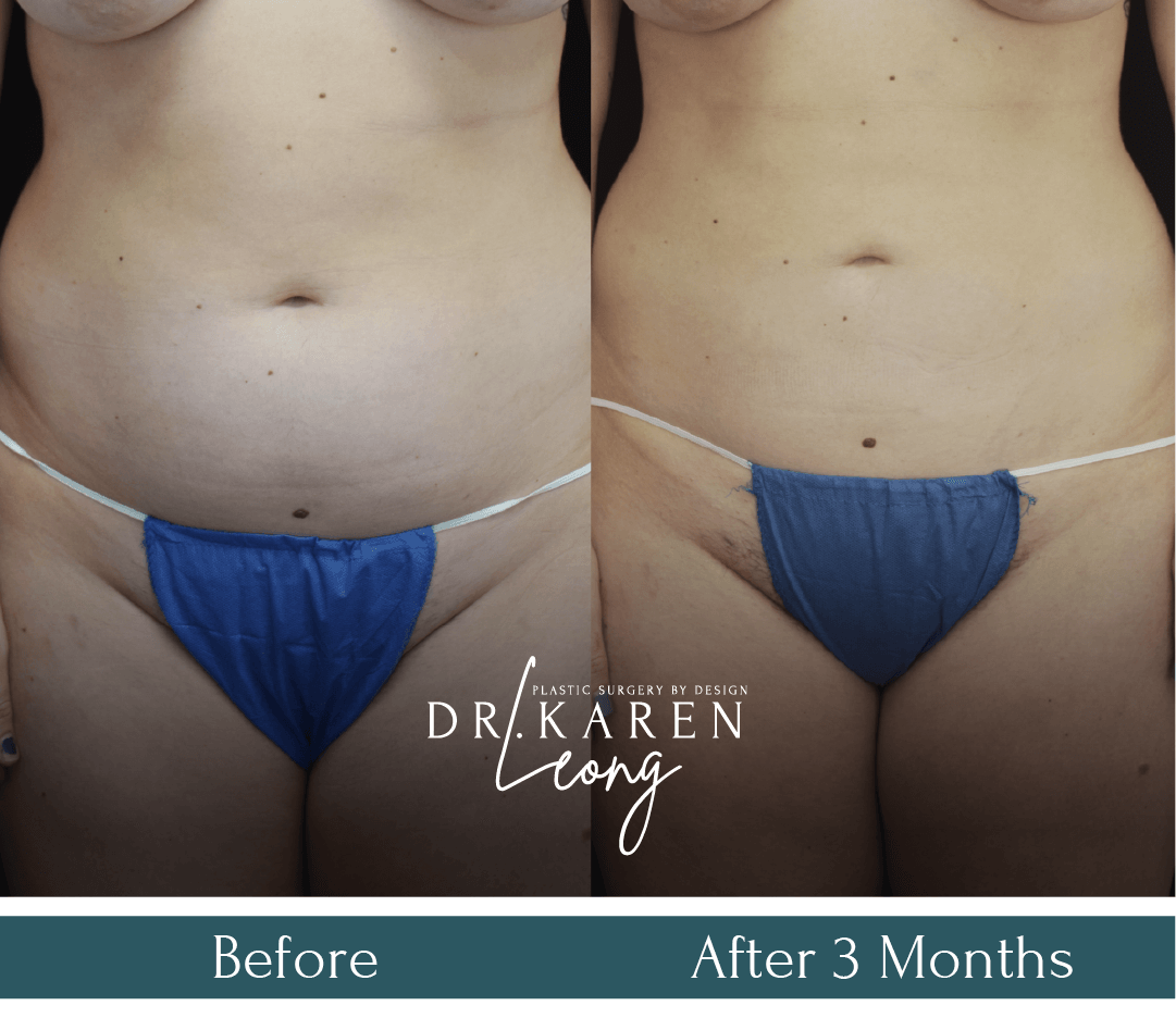 Dr Karen Leong Before After - Liposuction