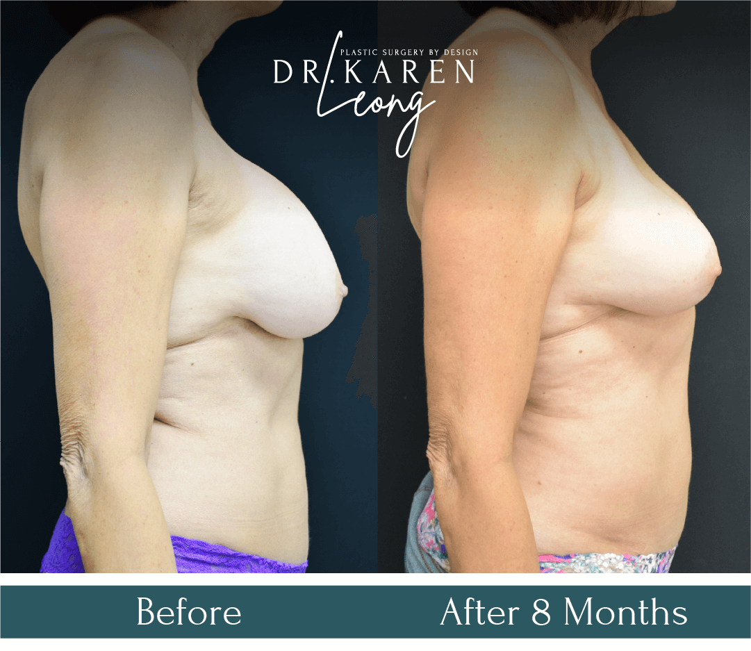 Dr Karen Leong Before After - Liposuction