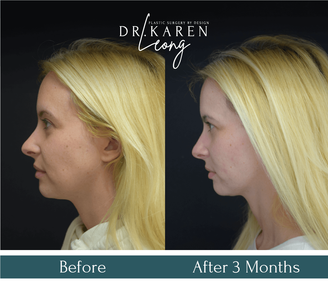 Dr-Karen-Leong-Before-After-RT-Buccal-Fat-Removal_0-copy-4.png