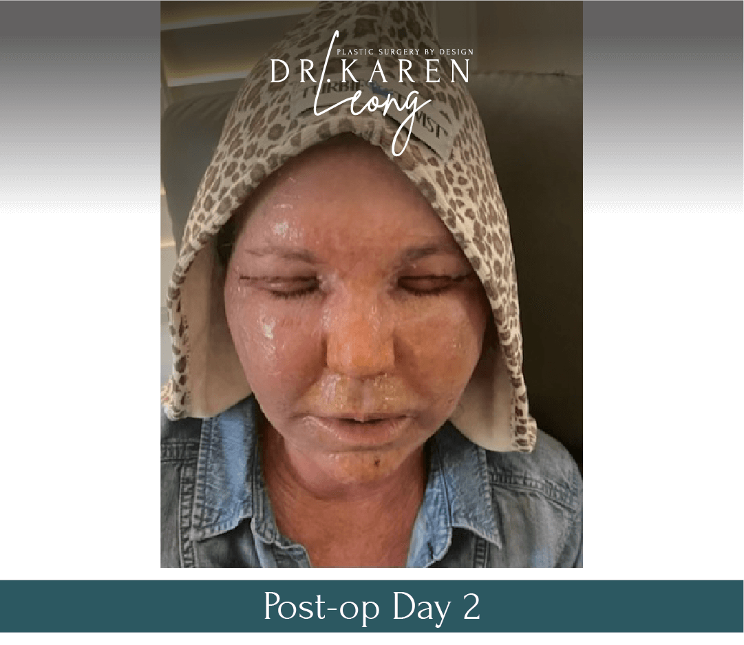 Dr-Karen-Leong-Before-After-Renuvion-Facial-Renewal_0-copy-2.png