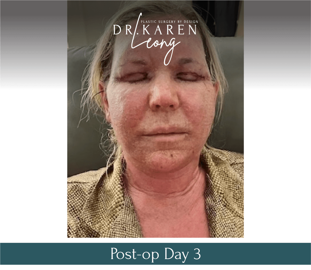 Dr-Karen-Leong-Before-After-Renuvion-Facial-Renewal_0-copy-3.png