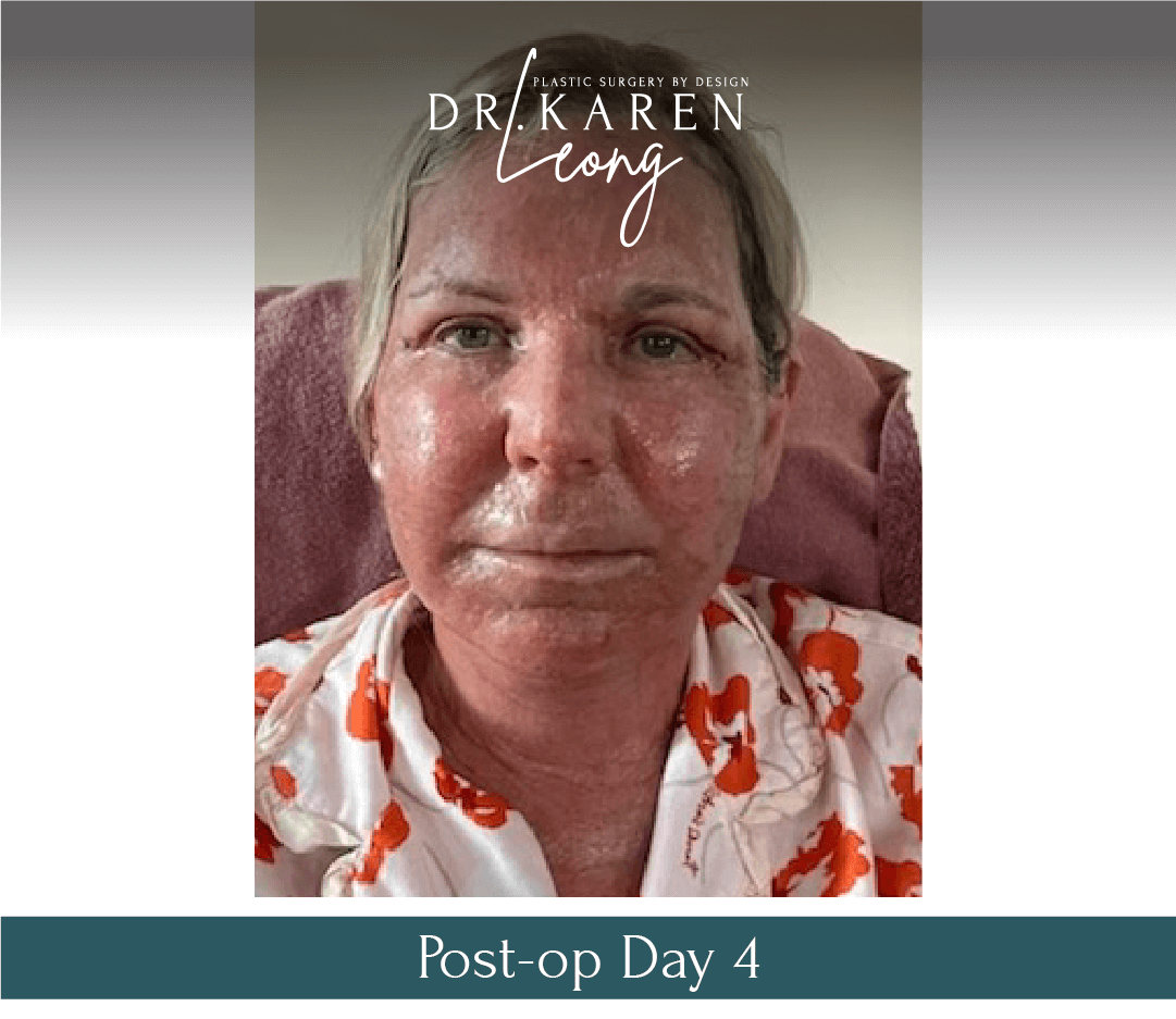Dr-Karen-Leong-Before-After-Renuvion-Facial-Renewal_0-copy-4.png