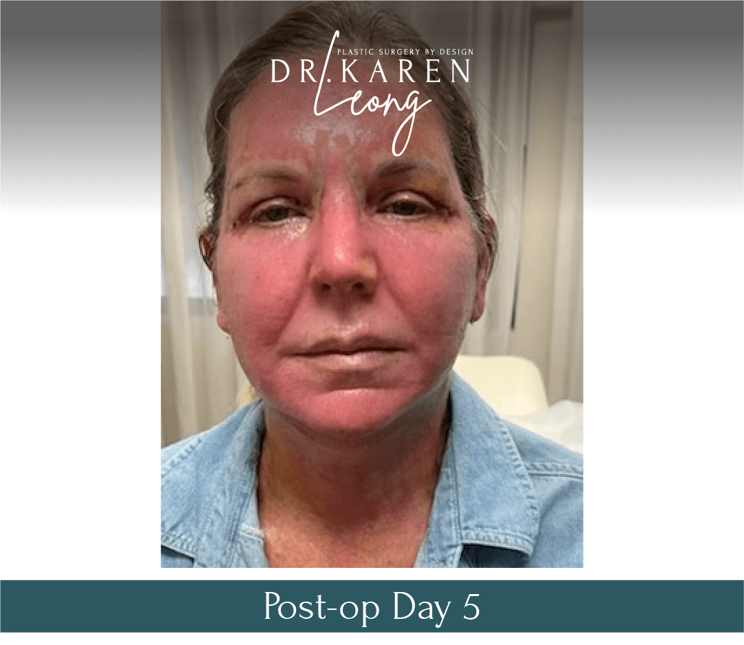 Dr-Karen-Leong-Before-After-Renuvion-Facial-Renewal_0-copy-5.png