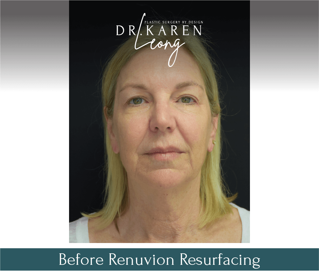 Dr-Karen-Leong-Before-After-Renuvion-Facial-Renewal_0.png