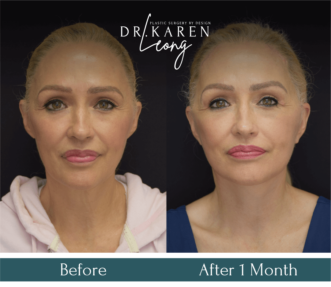 Dr Karen Leong Before After - Eyelid Lift