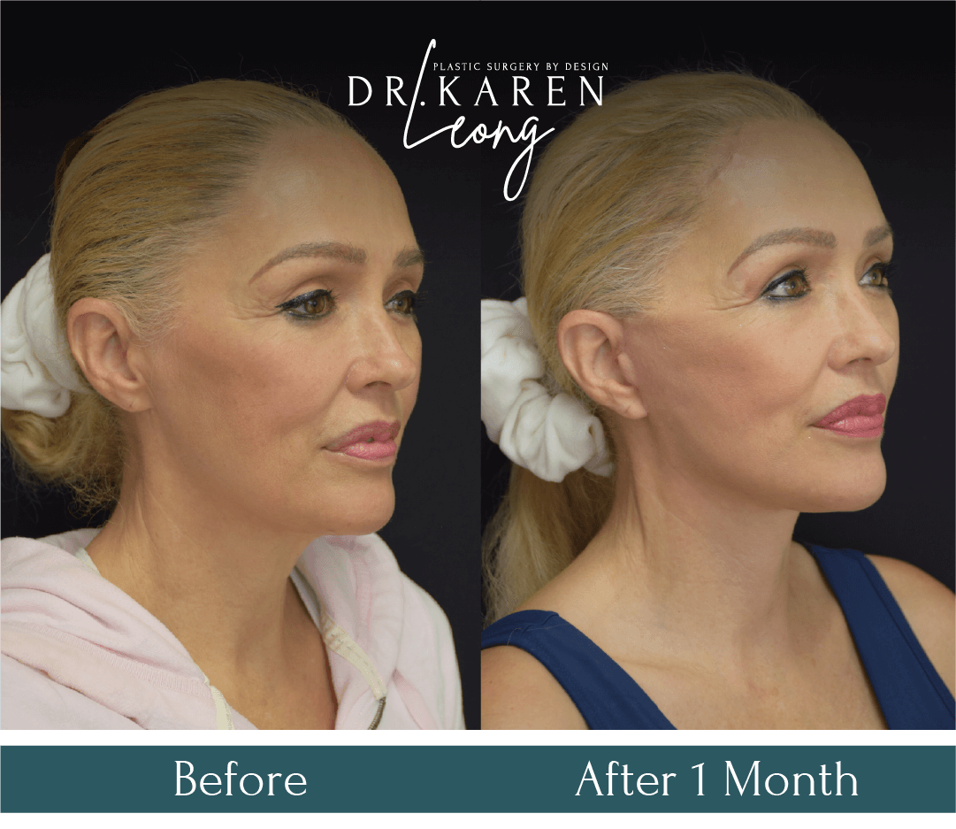 Dr-Karen-Leong-Before-After-SL-Upper-Bleph_-Lower-Face_-Neck-Lift_0-copy-5.png