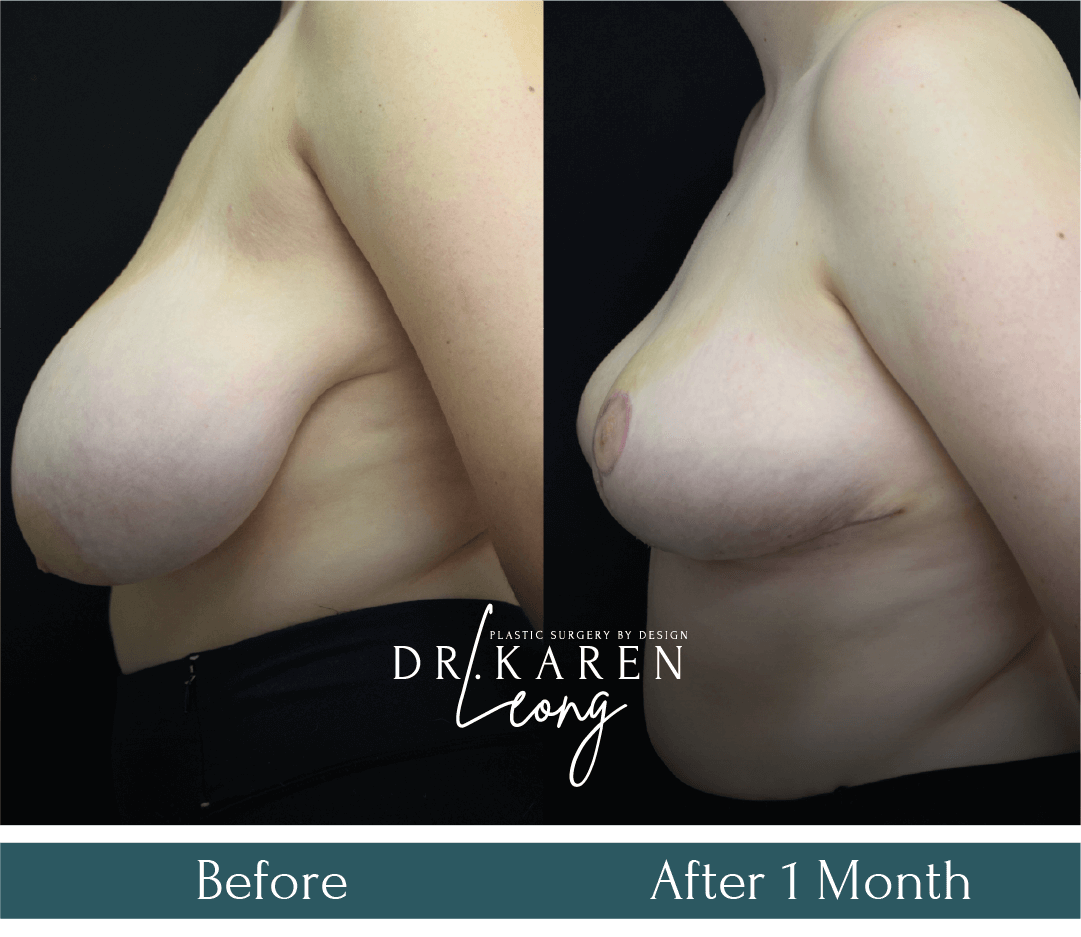Dr-Karen-Leong-Before-After-SS-Breast-Lift-_15-in-Dropbox-more-views_0-copy-2.png