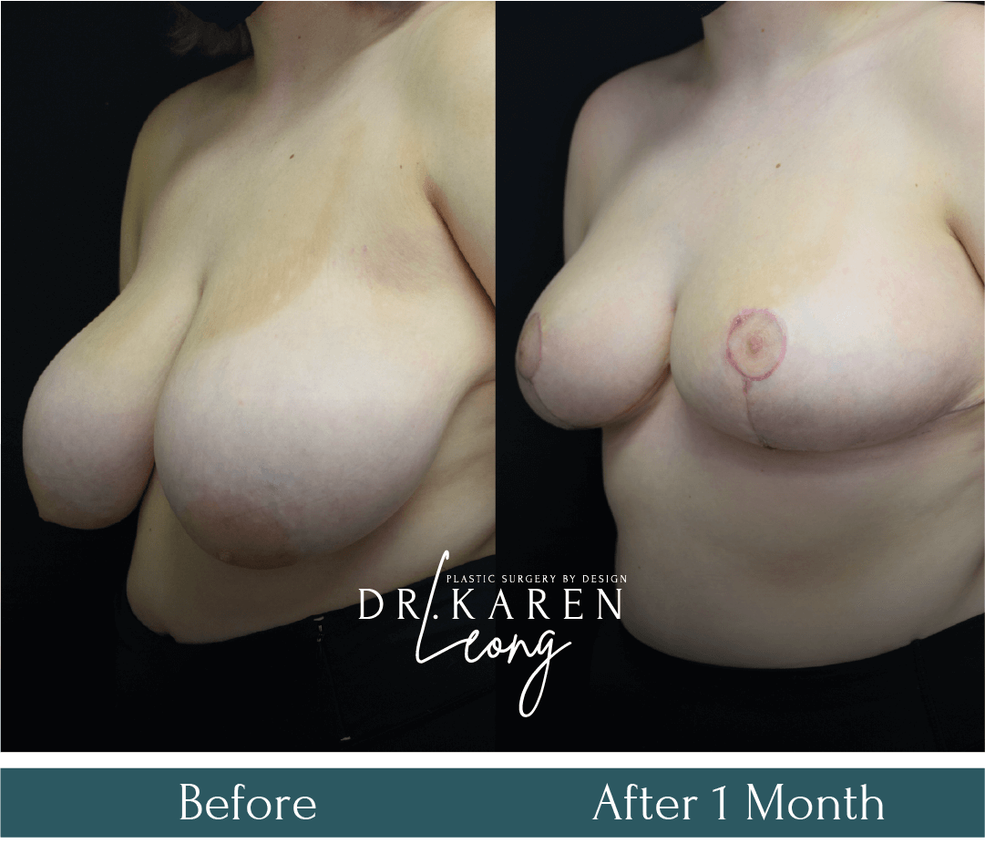 Dr-Karen-Leong-Before-After-SS-Breast-Lift-_15-in-Dropbox-more-views_0-copy-3.png
