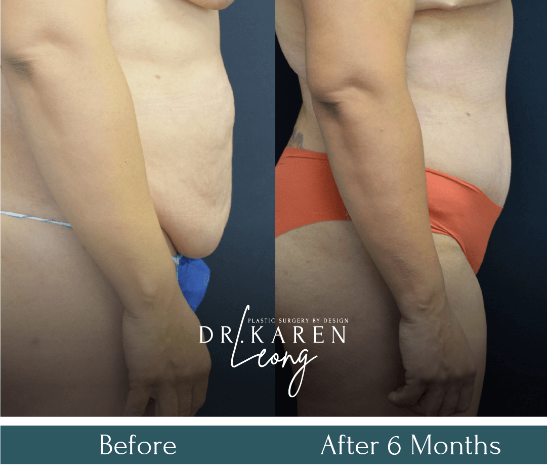 Dr Karen Leong Before After - Tummy Tuck