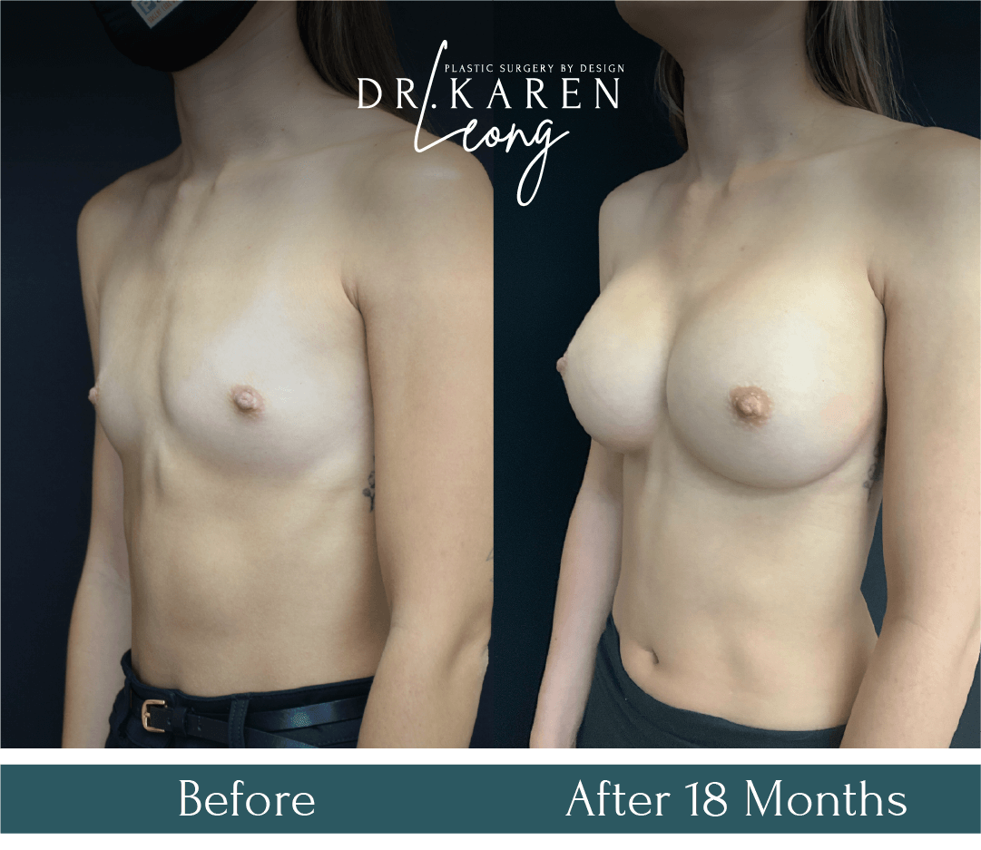 Dr Karen Leong Before After - Breast Augmentation