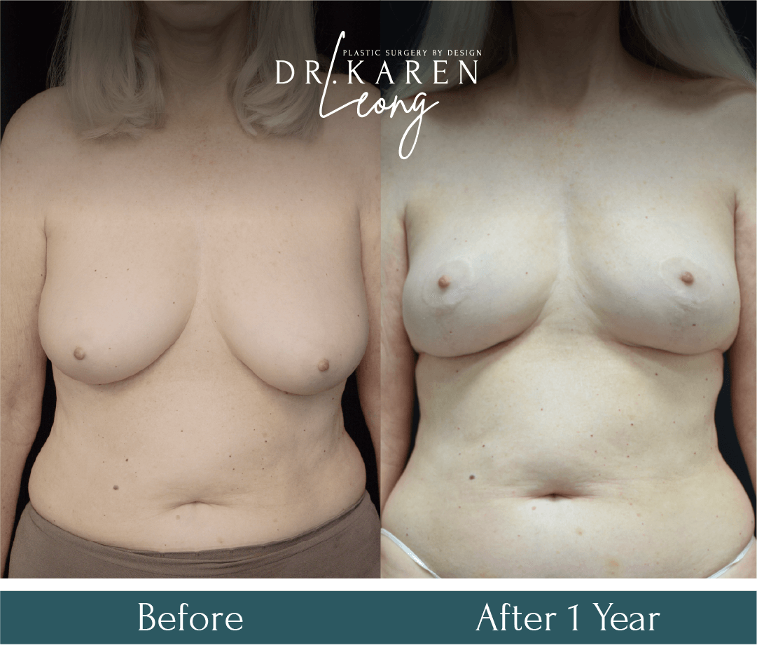 Dr Karen Leong Before After - Breast Lift