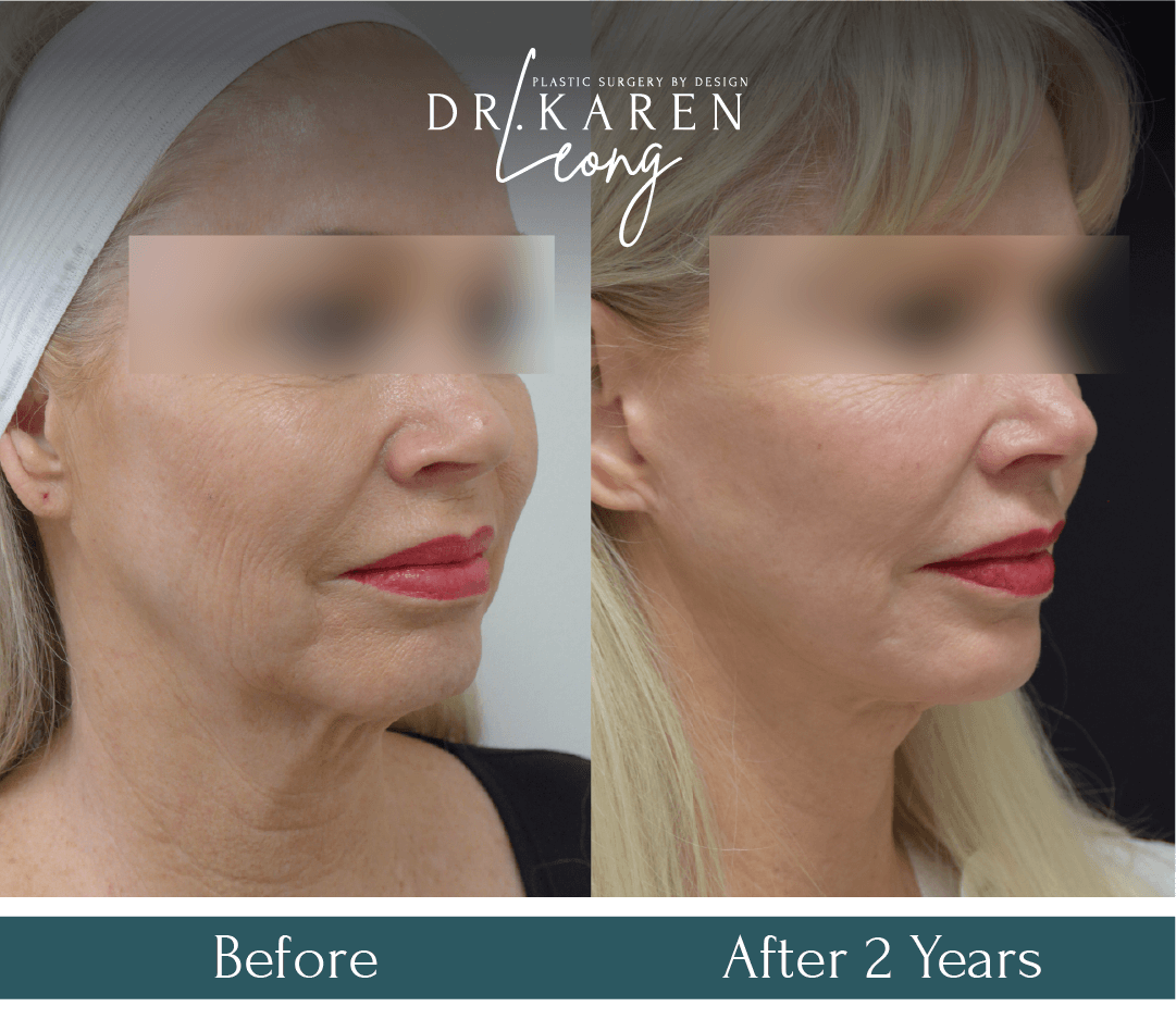 Dr Karen Leong Before After - Lower Face Neck Lift