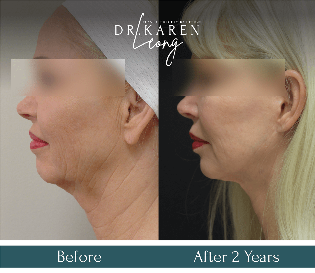 Dr Karen Leong Before After - Lower Face Neck Lift