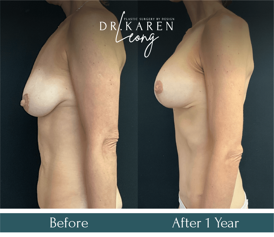 Dr Karen Leong Before After Sep 24 - Mommy Makeover_MZ copy 2