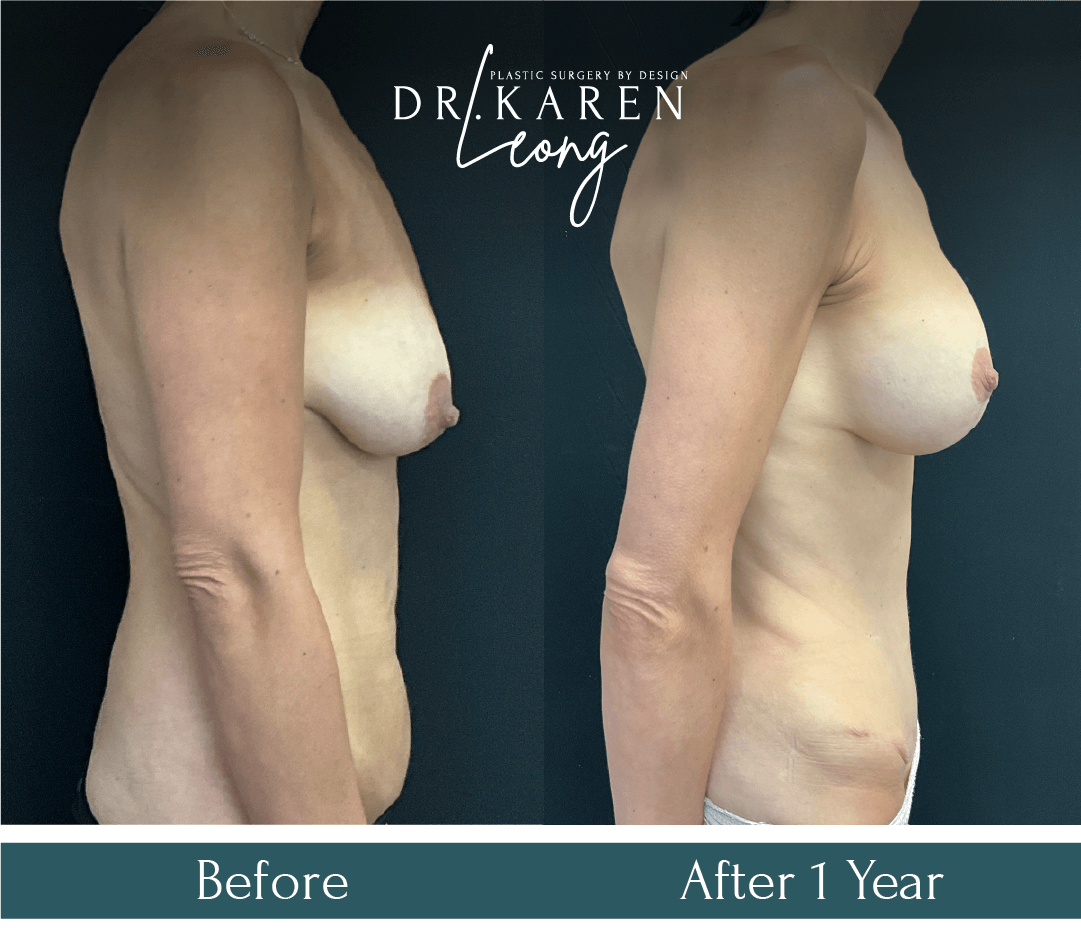 Dr Karen Leong Before After Sep 24 - Mommy Makeover_MZ copy