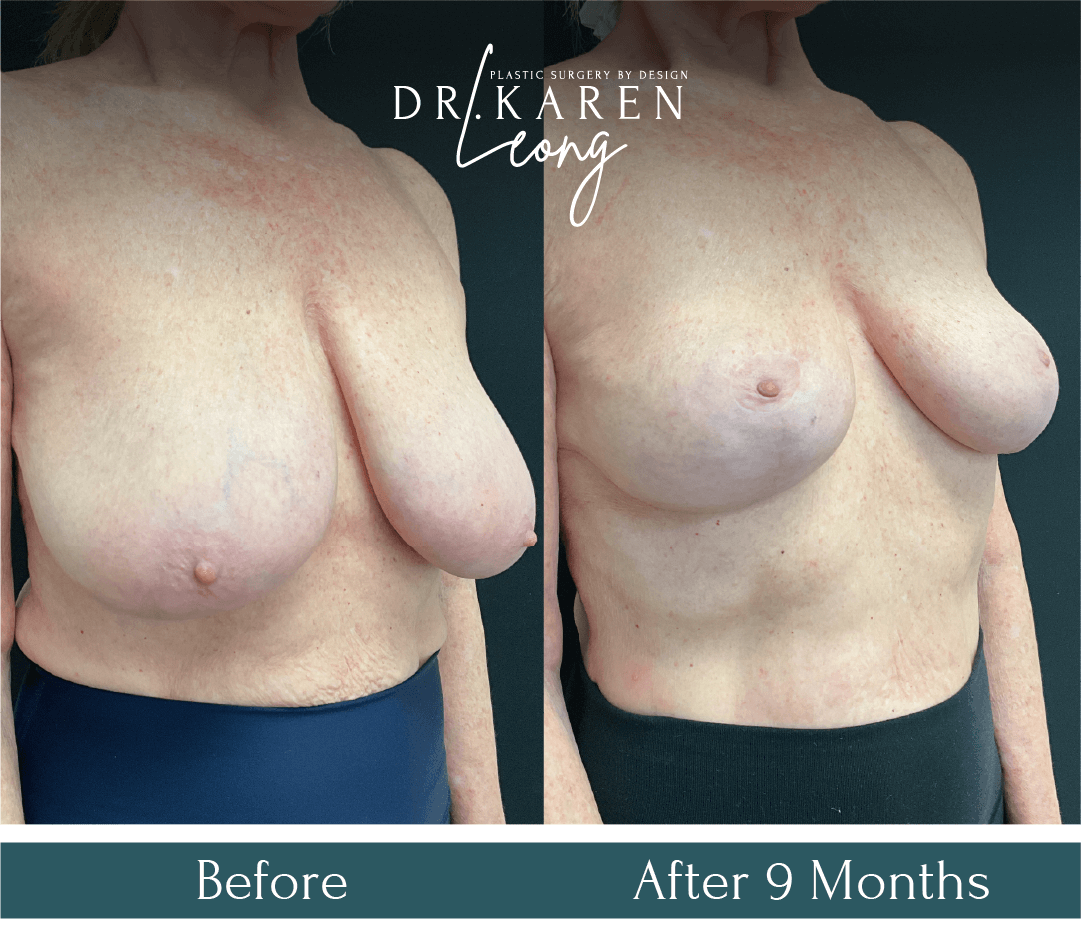 Dr Karen Leong Before After Jan 25 - Breast Reduction