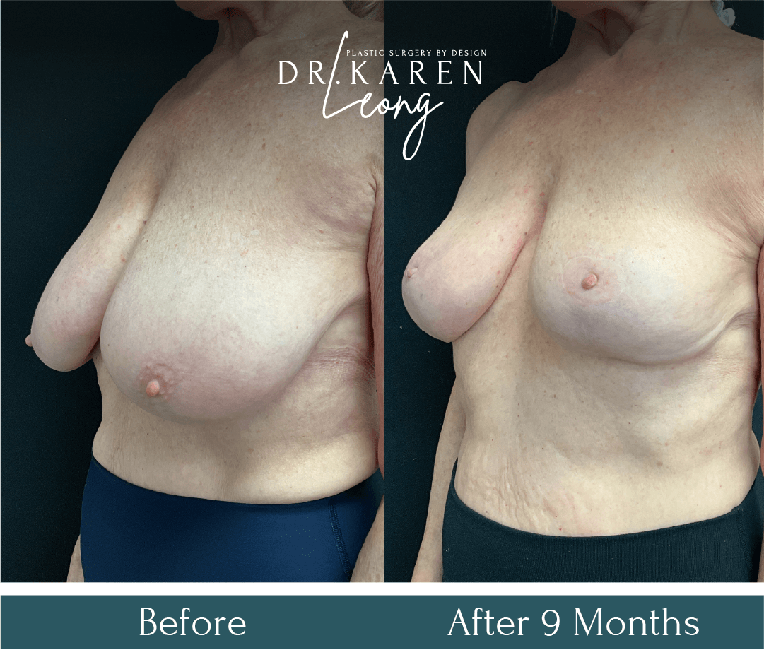 Dr Karen Leong Before After Jan 25 - Breast Reduction