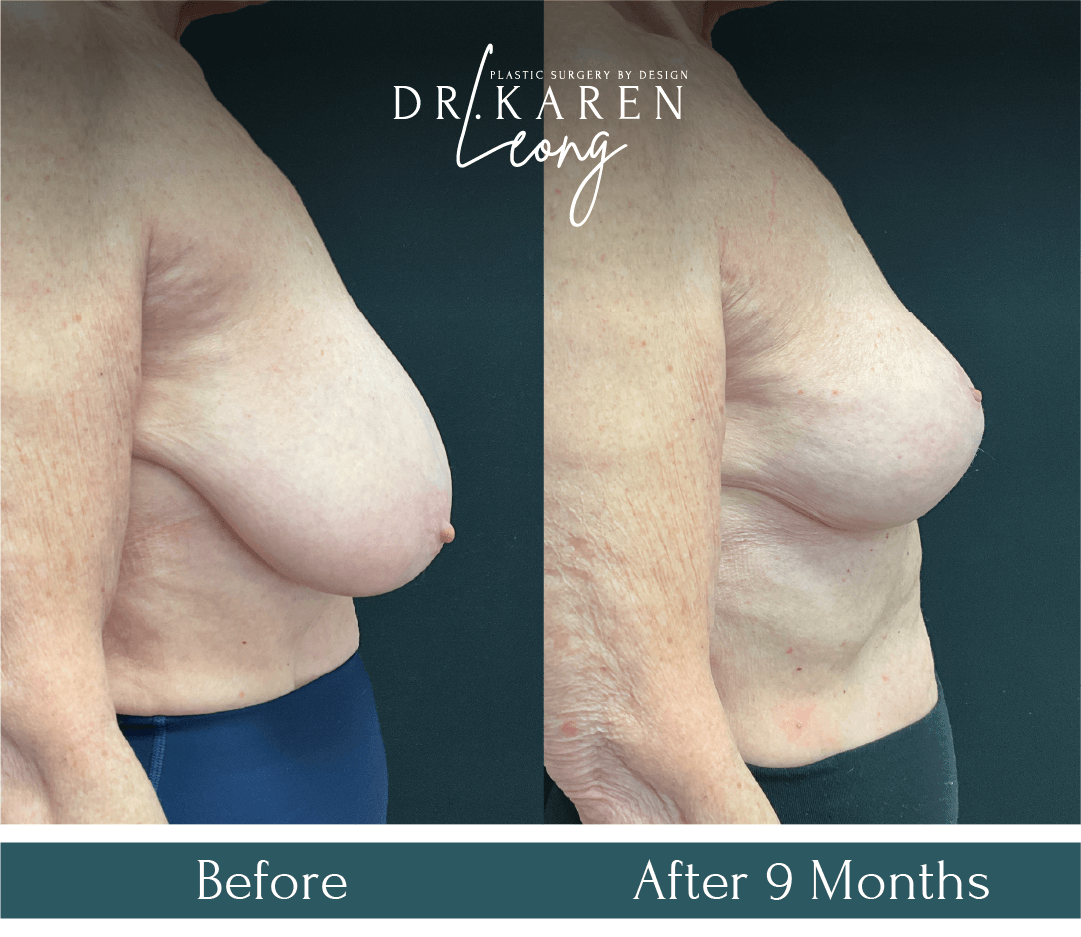 Dr Karen Leong Before After Jan 25 - Breast Reduction