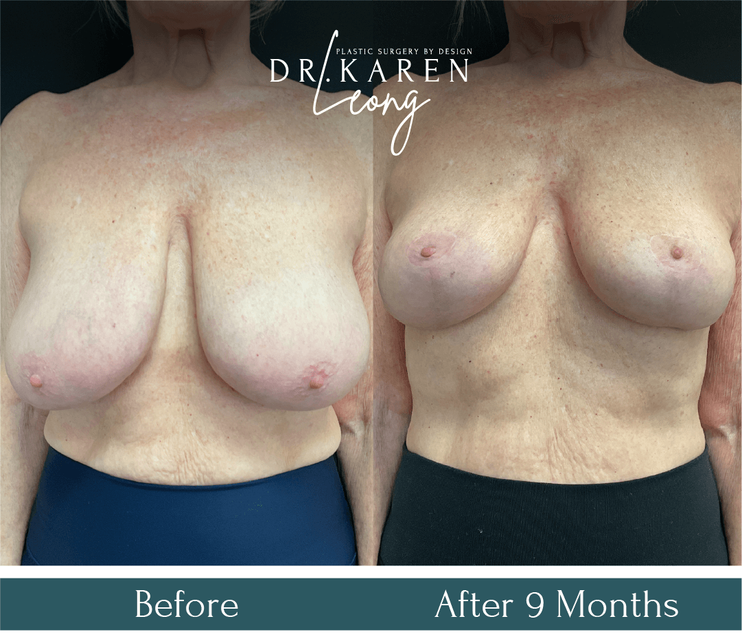 Dr Karen Leong Before After Jan 25 - Breast Reduction