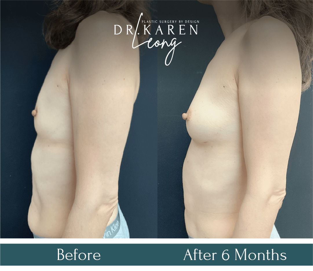 Dr Karen Leong Before After Jan 25 - Fat Transfer to Breast