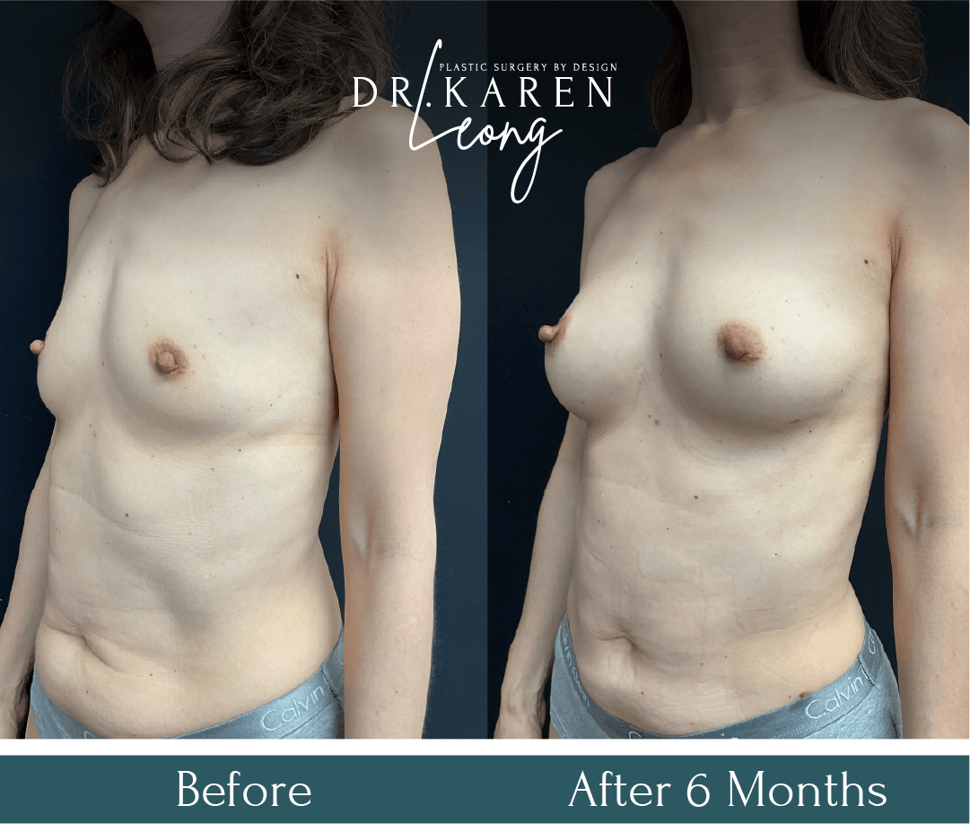 Dr Karen Leong Before After Jan 25 - Fat Transfer to Breast