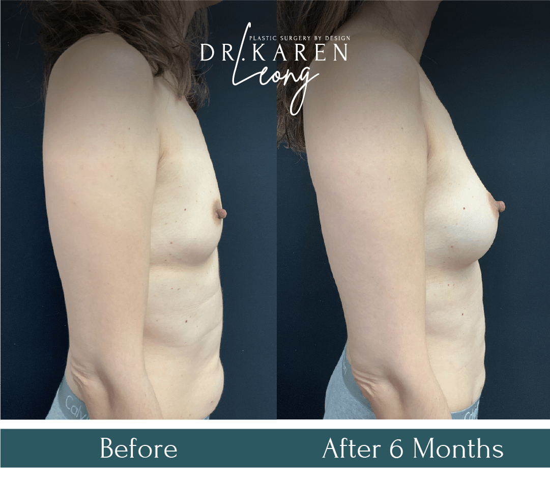 Dr Karen Leong Before After Jan 25 - Fat Transfer to Breast