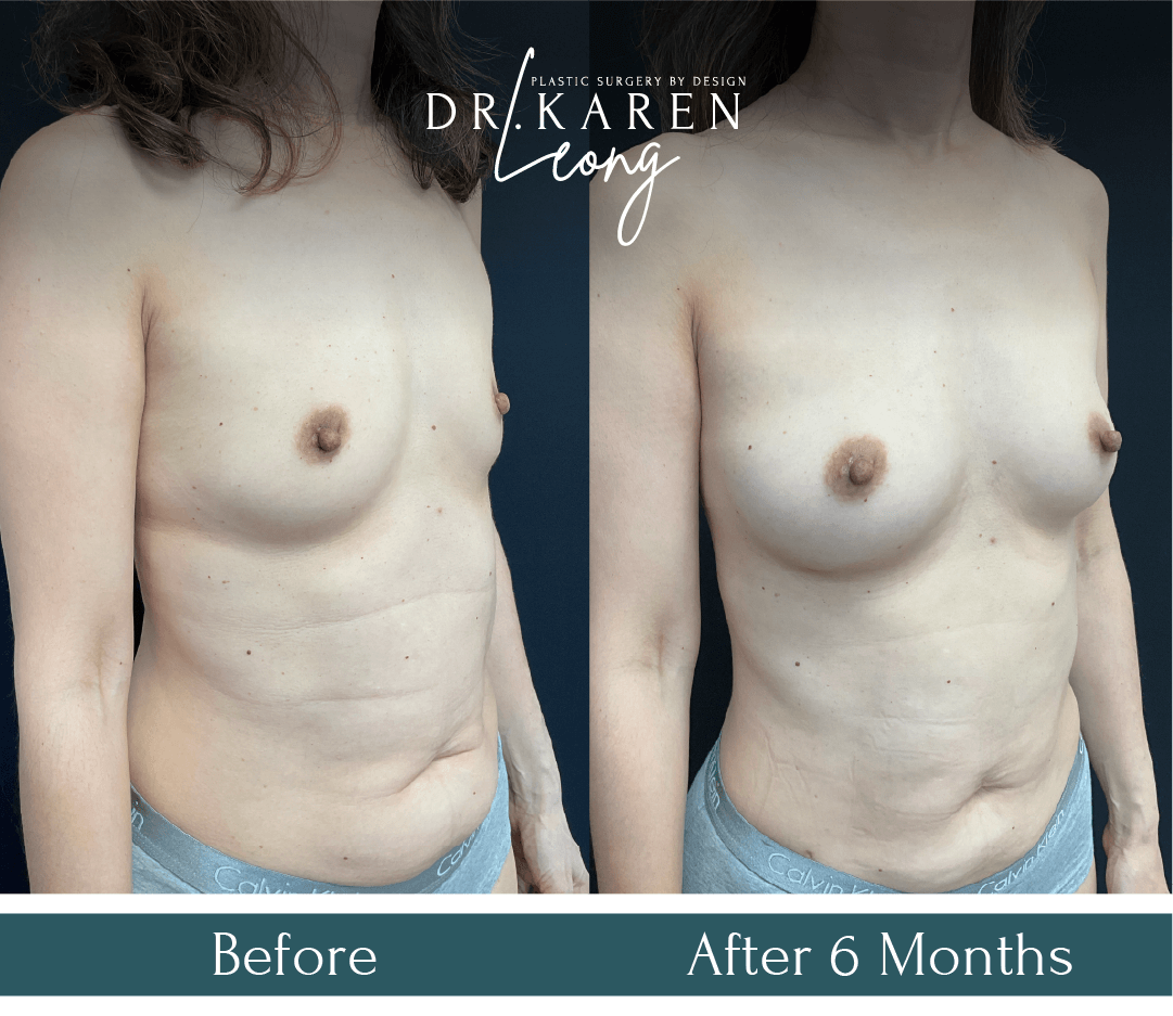 Dr Karen Leong Before After Jan 25 - Fat Transfer to Breast