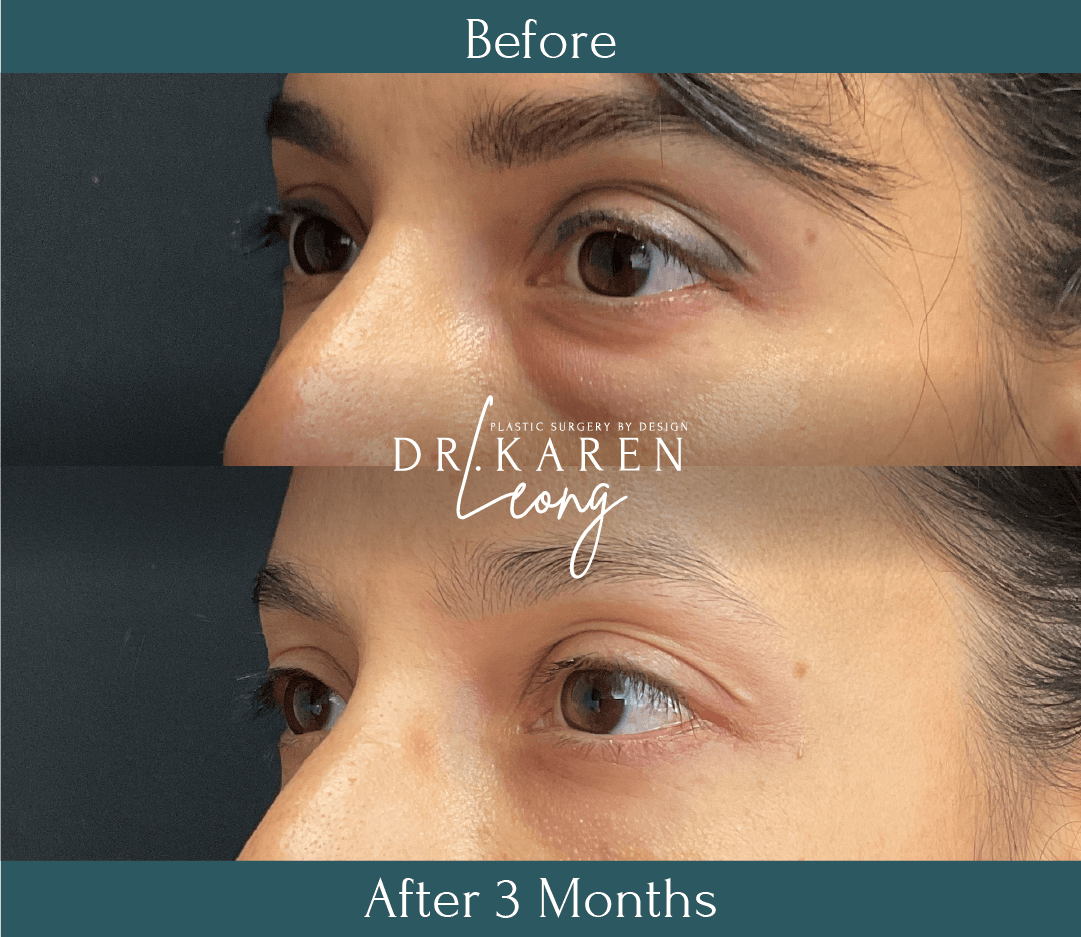 Dr Karen Leong Before After Jan 25 - Lower Bleph