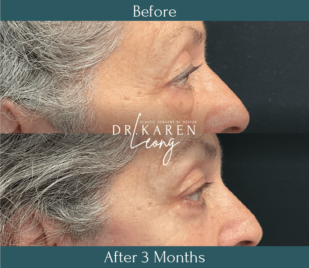 Dr Karen Leong Before After Jan 25 - Lower Bleph