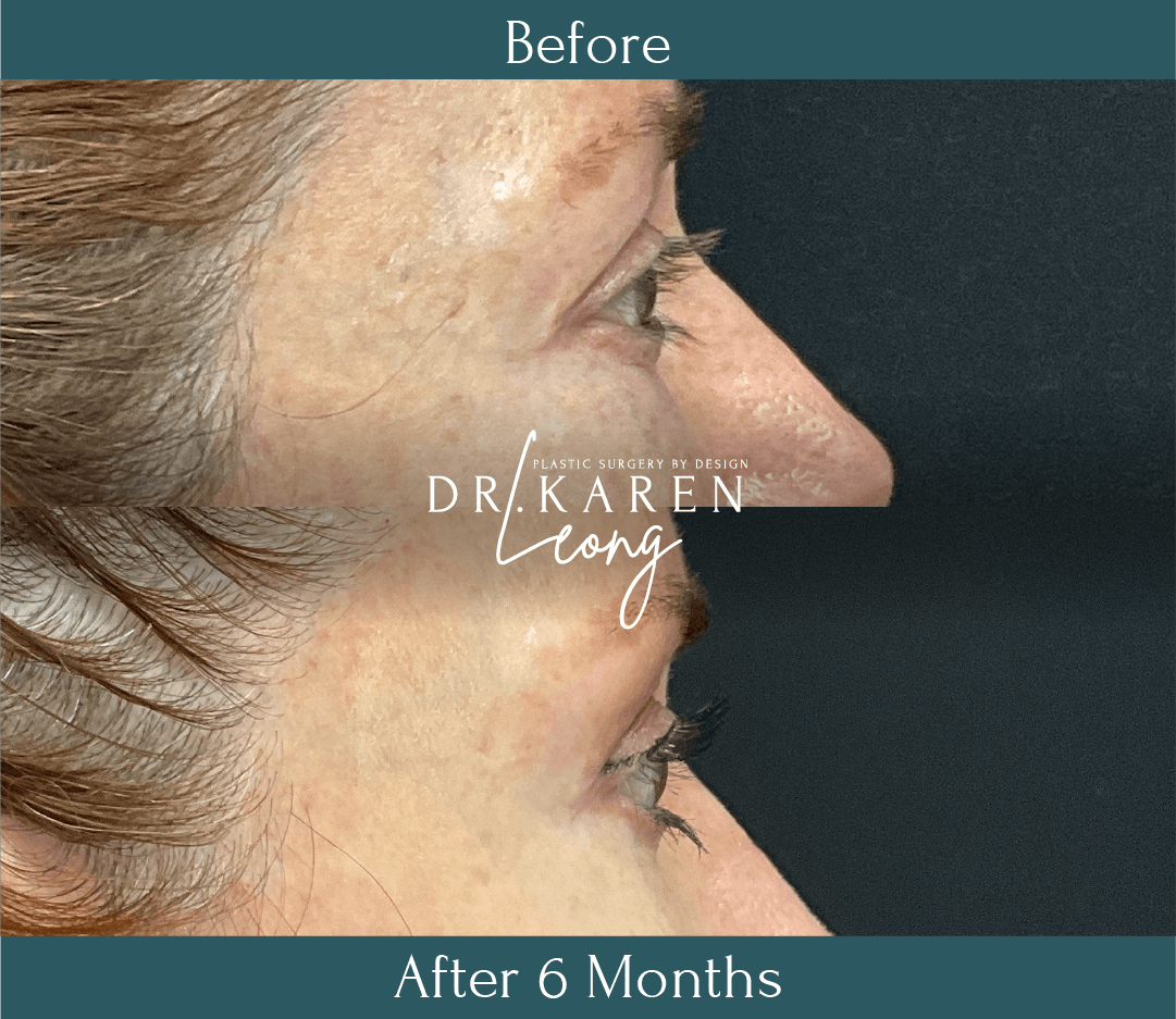 Dr Karen Leong Before After Jan 25 - Lower Bleph